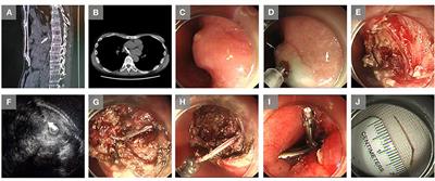 Extraction of Fish Bones Embedded in the Esophagus via Endoscopic Submucosal Dissection: Two Case Reports and Literature Review